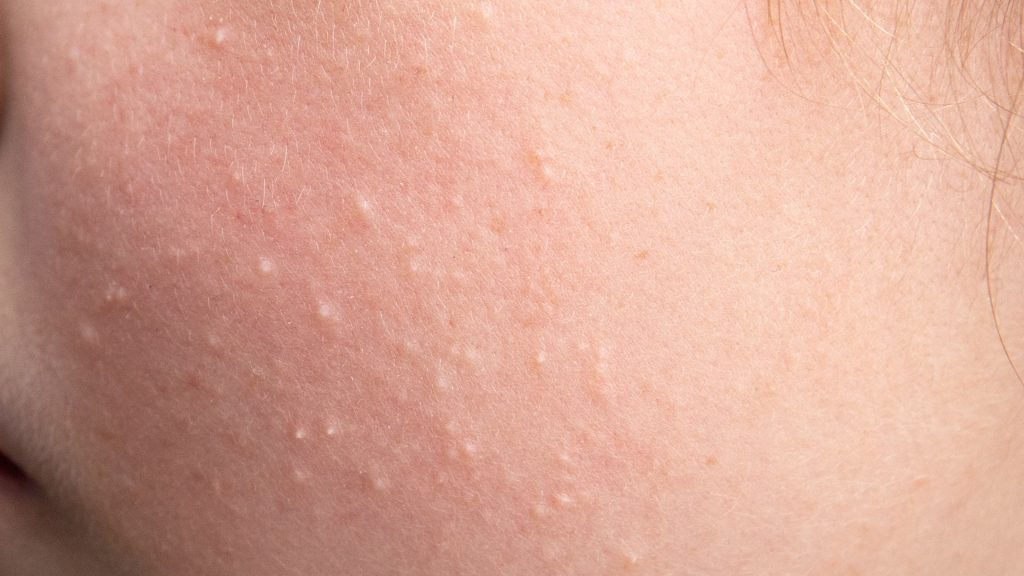 Se você já notou pequenas bolinhas brancas ou amareladas, especialmente ao redor dos olhos ou do nariz, é bem possível que tenha se deparado com um tipo comum de lesão de pele chamado milium. Apesar de não causar dor, esse acúmulo de queratina sob a pele pode incomodar visualmente e exige cuidados dermatológicos específicos.