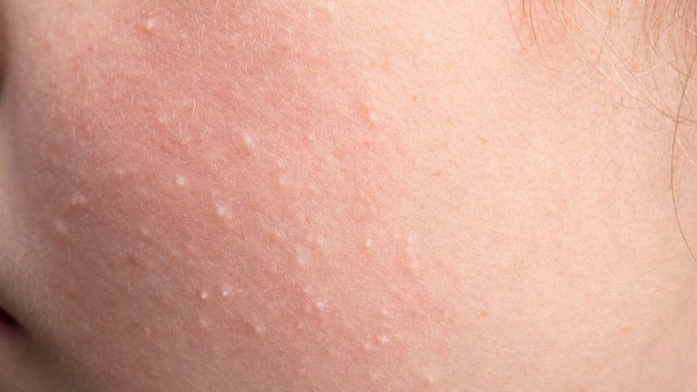Se você já notou pequenas bolinhas brancas ou amareladas, especialmente ao redor dos olhos ou do nariz, é bem possível que tenha se deparado com um tipo comum de lesão de pele chamado milium. Apesar de não causar dor, esse acúmulo de queratina sob a pele pode incomodar visualmente e exige cuidados dermatológicos específicos.