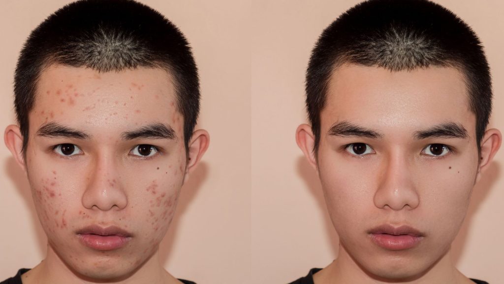 Antes de tudo, muitas pessoas reconhecem o Roacutan®, nome comercial da isotretinoína, como um dos tratamentos mais eficazes para acne severa e resistente. Por isso, muitos passaram a chamá-lo de “pílula da beleza”, já que os resultados na pele impressionam. Ainda assim, apesar dos benefícios, o uso do Roacutan® exige acompanhamento médico constante, justamente pelos riscos envolvidos.